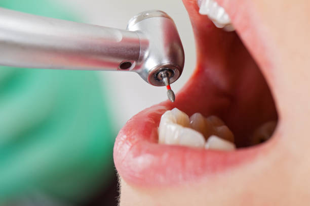 Best Emergency Tooth Extraction in Versailles, PA